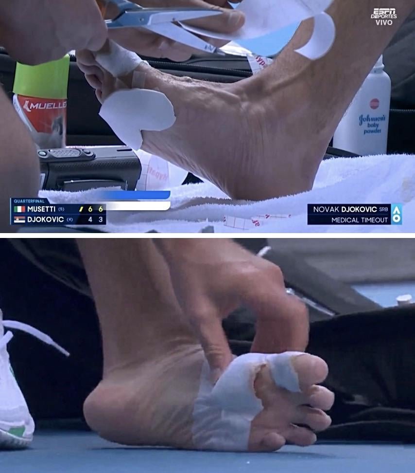 novaks-blister-during-his-qf-against-lore-musetti-v0-70wjqhifo1gg1.jpeg